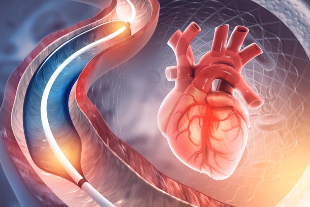 what is Coronary Angiography