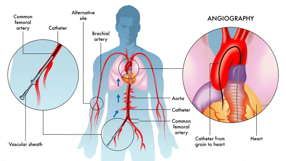 Coronary Angiography in Andheri, Mumbai
