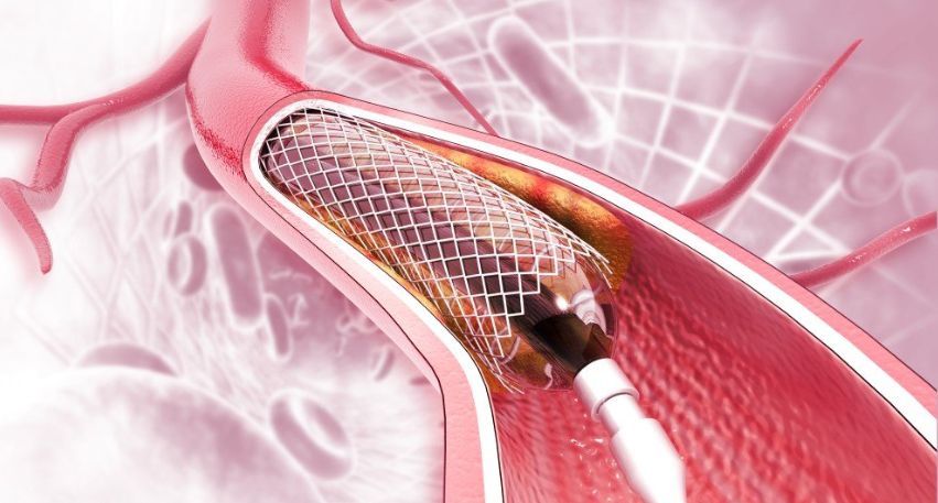 Coronary Angioplasty in Andheri, Mumbai