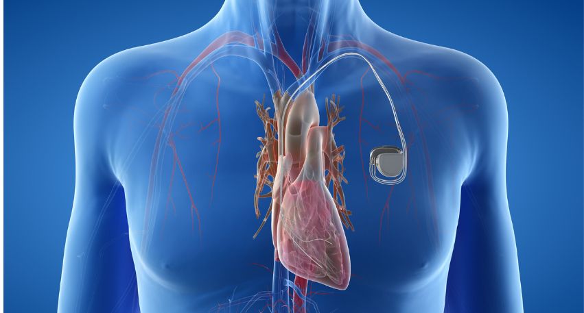 Pacemaker Implantation in Andheri, Mumbai